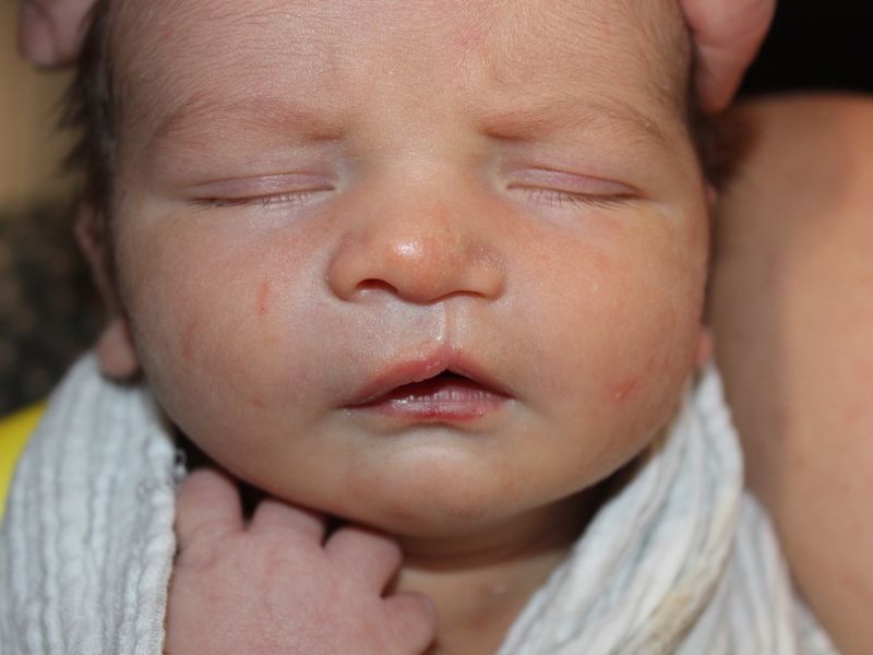 An infant boy with a cleft lip before surgery.